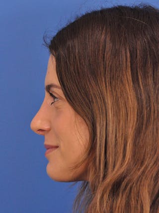 Rhinoplasty Before & After Gallery - Patient 574327 - Image 10