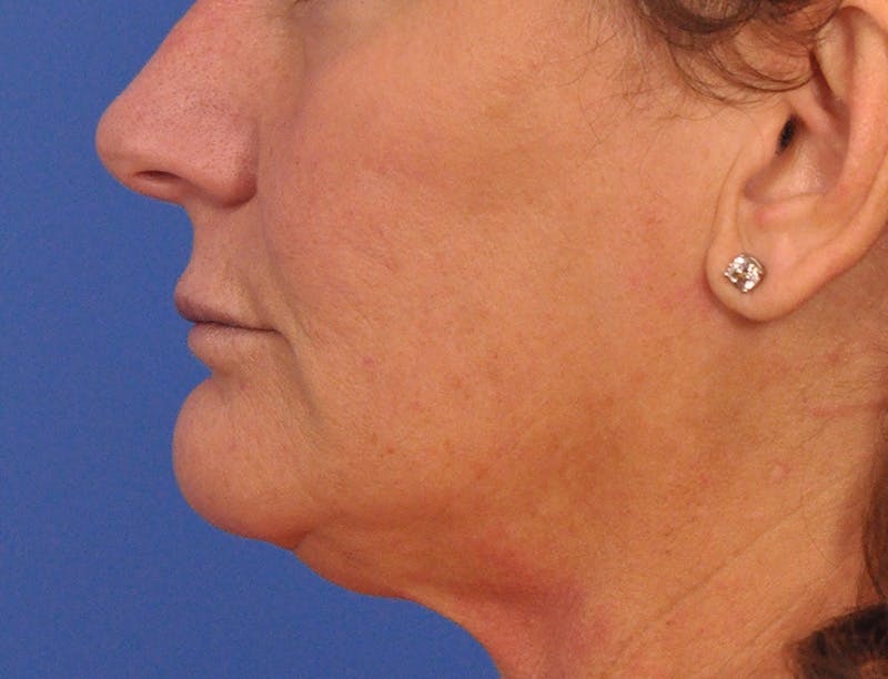 Lip Lift Before & After Gallery - Patient 271870 - Image 11