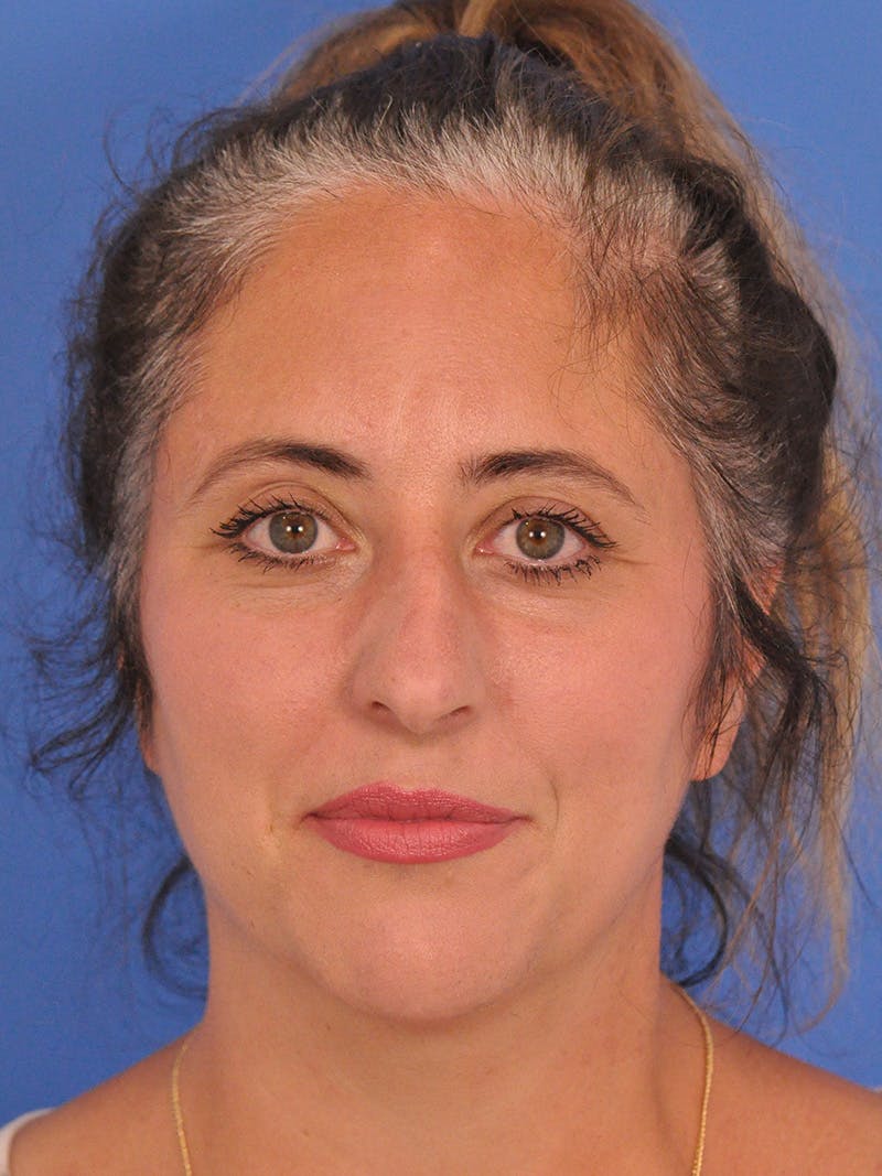 Rhinoplasty Before & After Gallery - Patient 347488 - Image 5