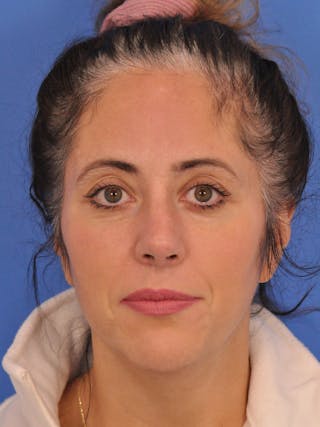 Rhinoplasty Before & After Gallery - Patient 347488 - Image 6