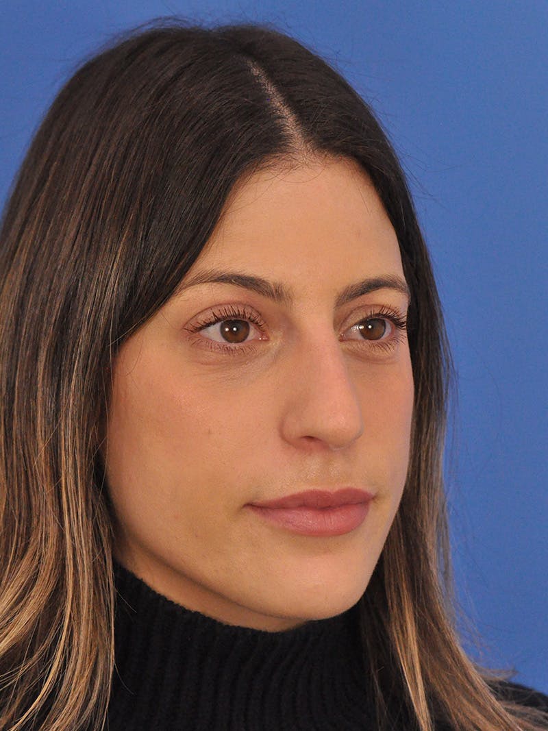 Rhinoplasty Before & After Gallery - Patient 574327 - Image 3