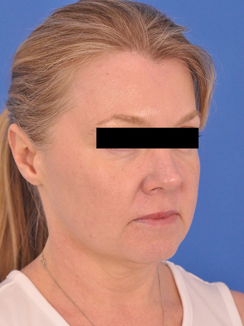 Facelift Before & After Gallery - Patient 202421 - Image 3