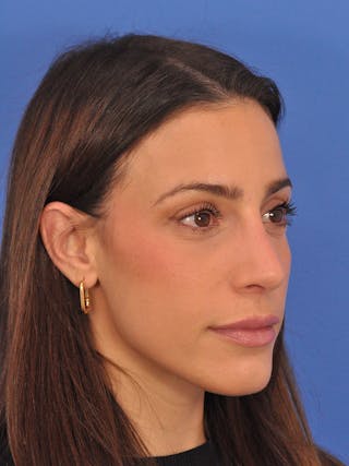 Rhinoplasty Before & After Gallery - Patient 100951 - Image 4