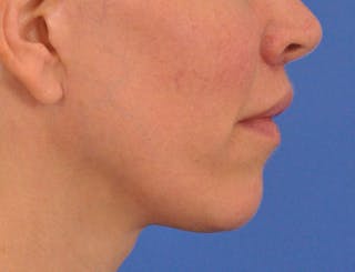 Lip Lift Before & After Gallery - Patient 336999 - Image 8
