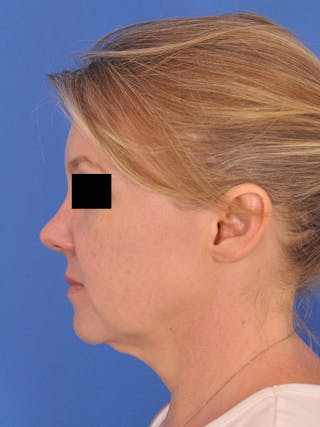 Facelift Before & After Gallery - Patient 202421 - Image 10