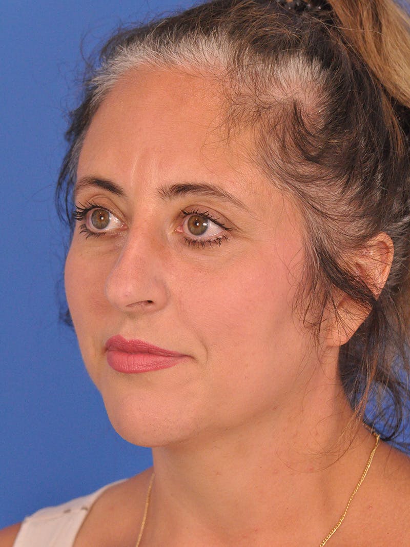 Rhinoplasty Before & After Gallery - Patient 347488 - Image 7