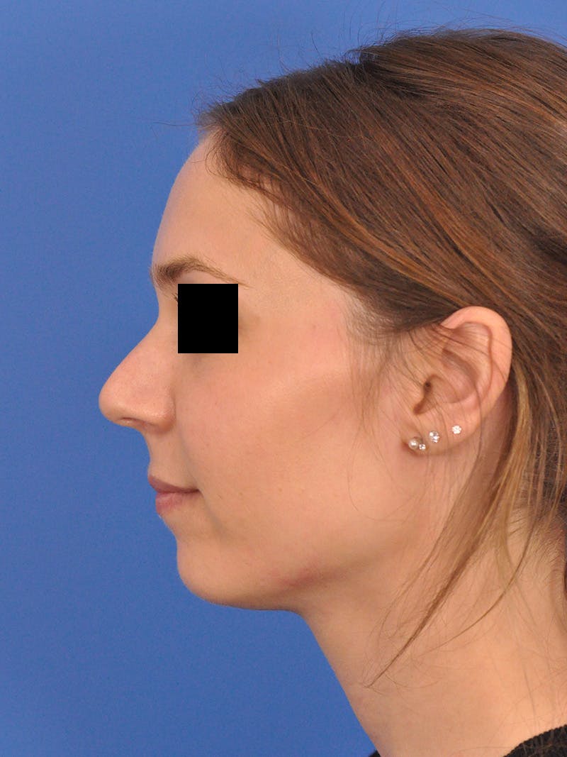Rhinoplasty Before & After Gallery - Patient 230732 - Image 9