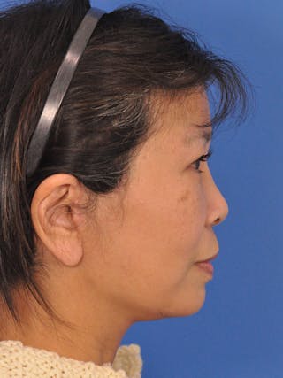 Facelift Before & After Gallery - Patient 227711 - Image 6