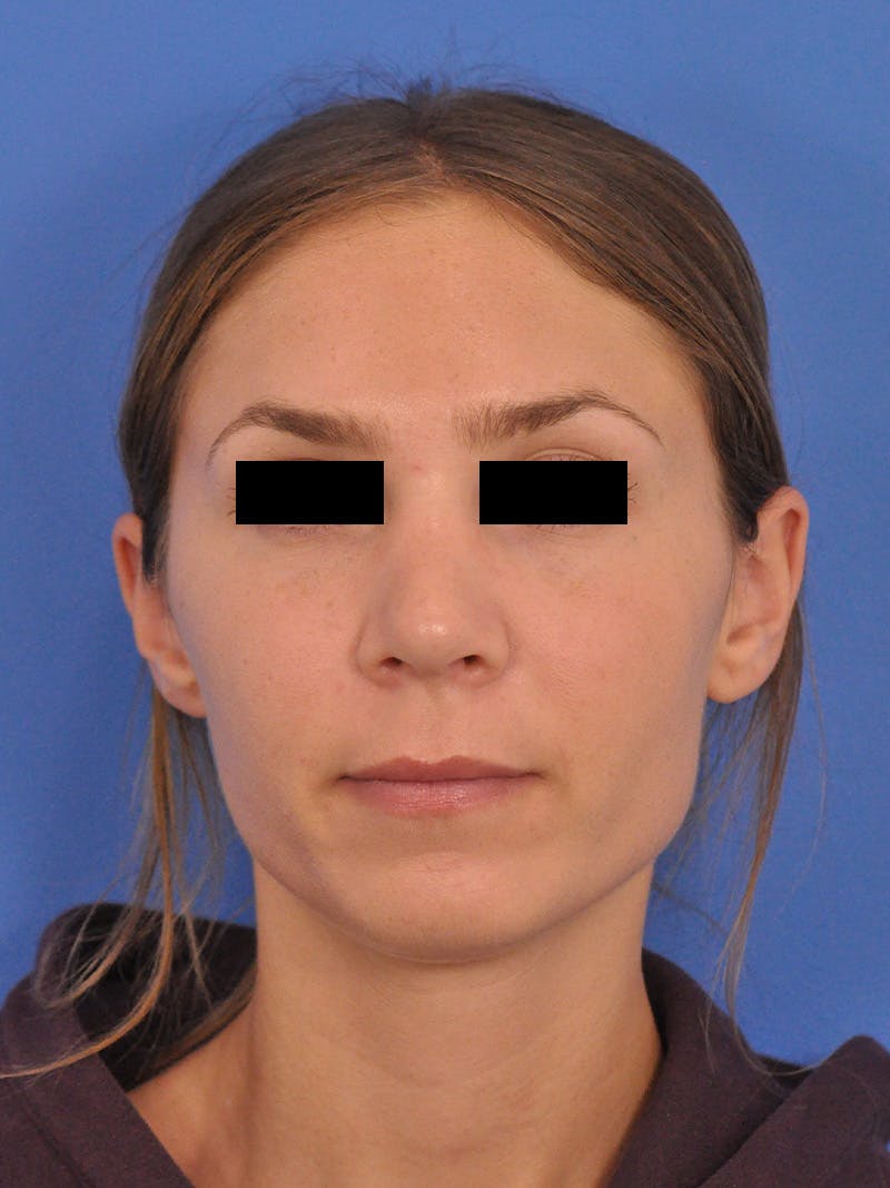 Rhinoplasty Before & After Gallery - Patient 230732 - Image 6