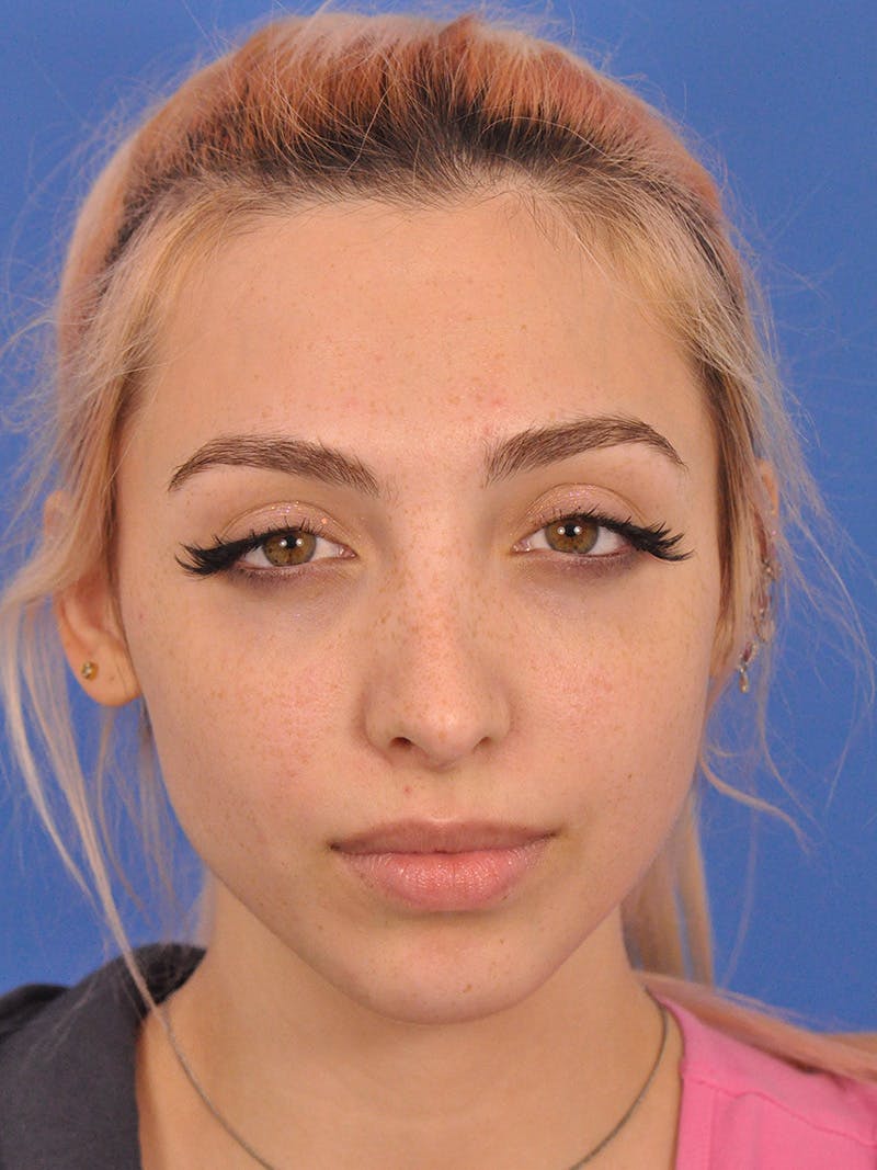 Rhinoplasty Before & After Gallery - Patient 192652 - Image 6