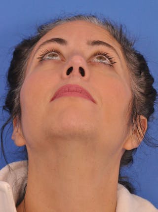 Rhinoplasty Before & After Gallery - Patient 347488 - Image 12