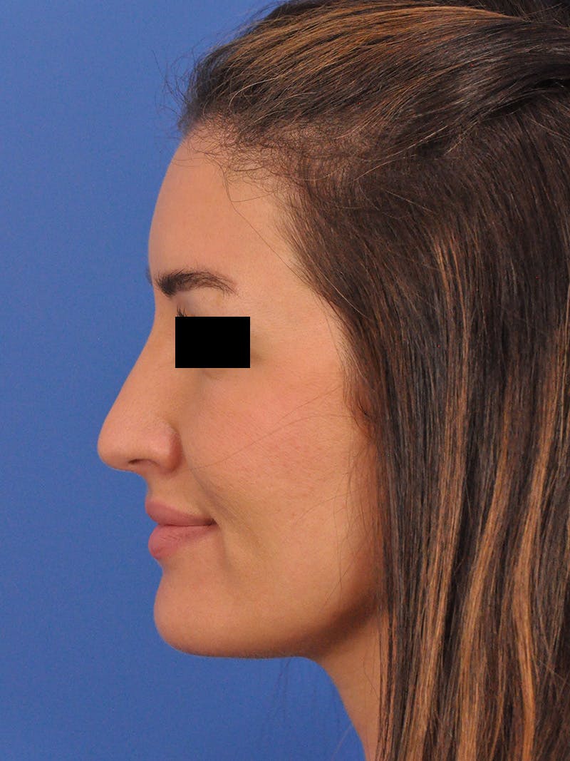 Brow Lift Before & After Gallery - Patient 233430 - Image 6