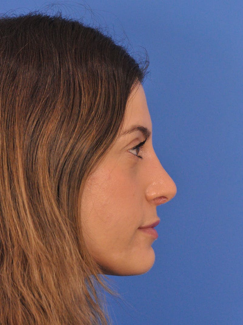 Rhinoplasty Before & After Gallery - Patient 574327 - Image 2
