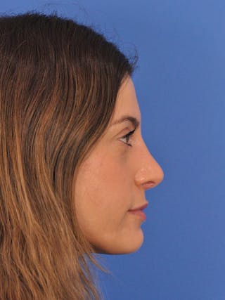Rhinoplasty Before & After Gallery - Patient 574327 - Image 2