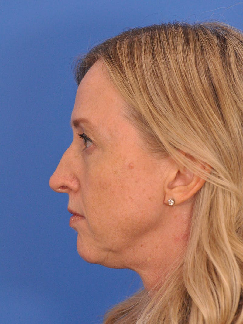 Rhinoplasty Before & After Gallery - Patient 315321 - Image 11
