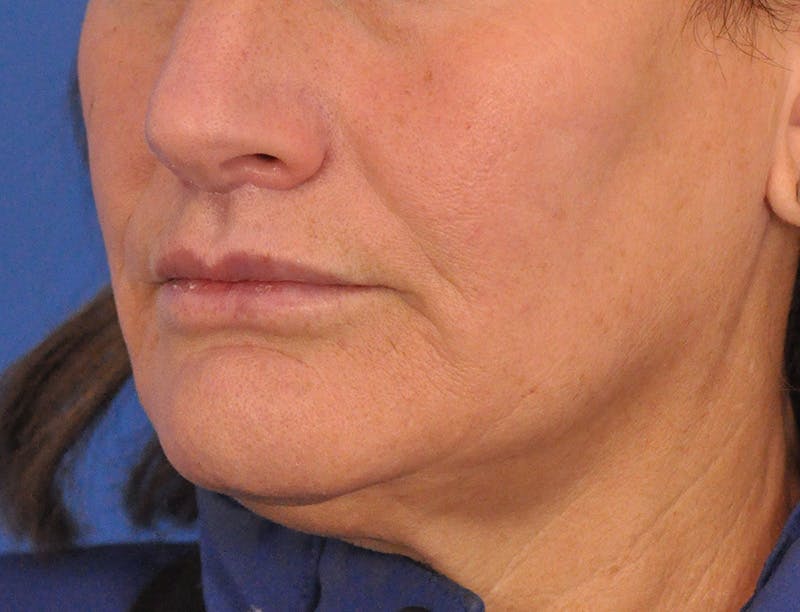Lip Lift Before & After Gallery - Patient 271870 - Image 10