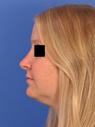 Rhinoplasty Before & After Gallery - Patient 157621 - Image 10