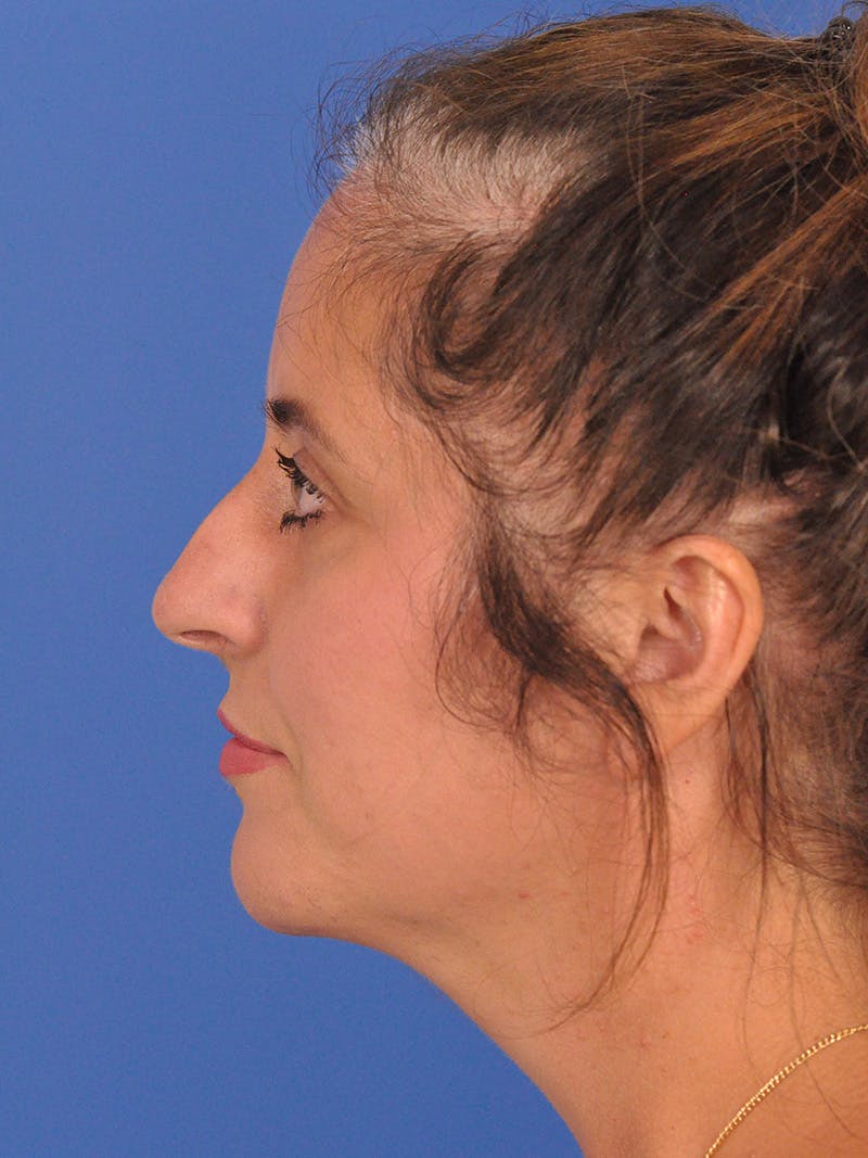 Rhinoplasty Before & After Gallery - Patient 347488 - Image 9