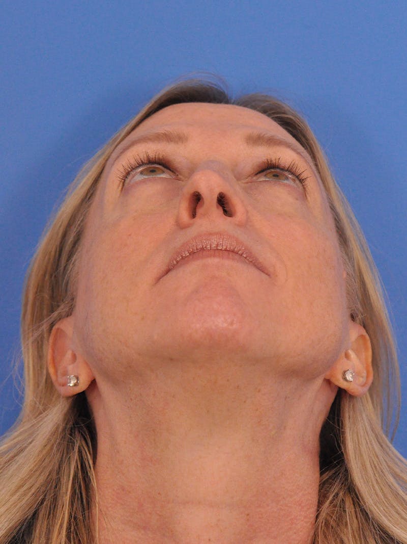 Rhinoplasty Before & After Gallery - Patient 315321 - Image 7