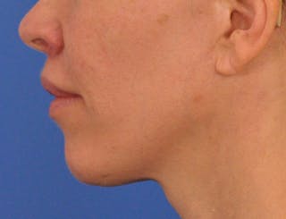 Lip Lift Before & After Gallery - Patient 336999 - Image 12