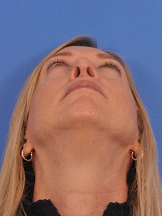 Rhinoplasty Before & After Gallery - Patient 315321 - Image 8