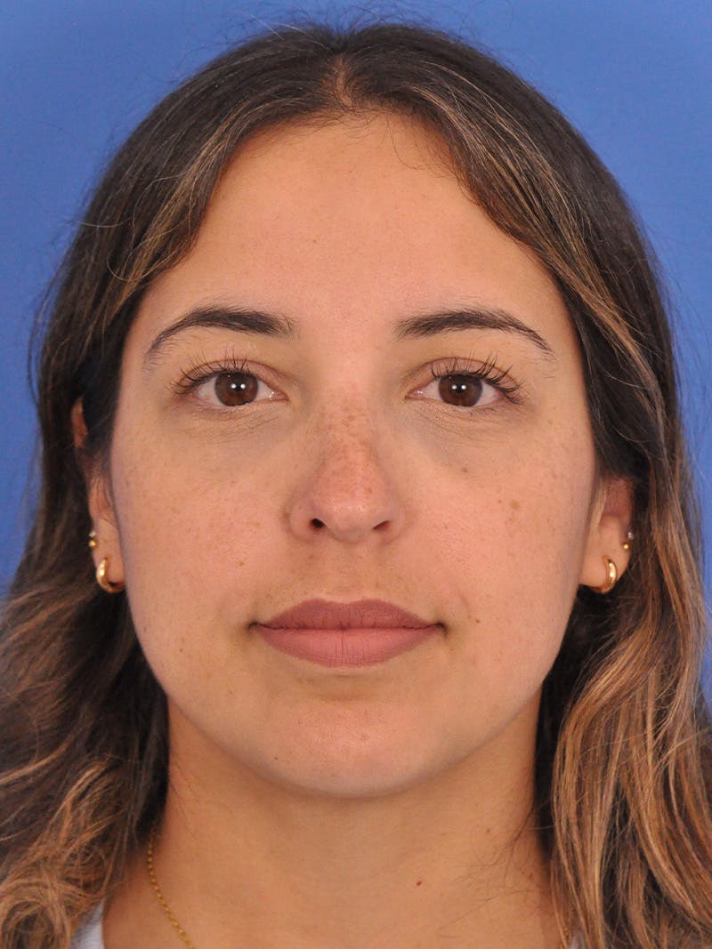 Rhinoplasty Before & After Gallery - Patient 277111 - Image 5