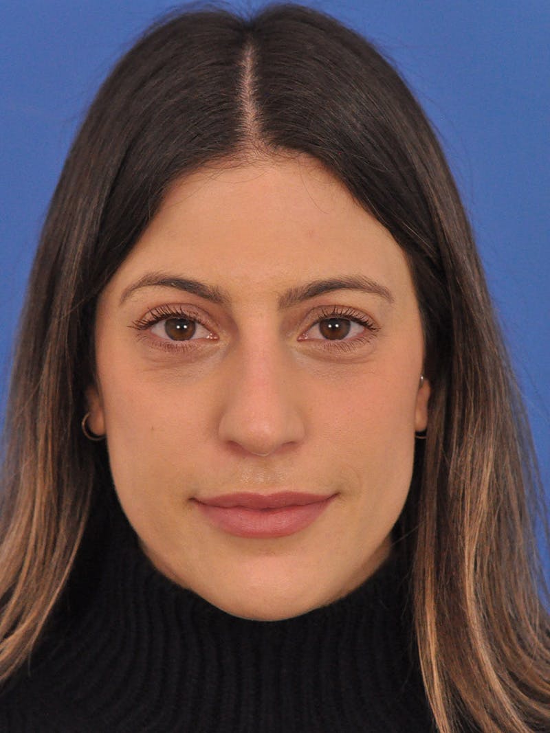 Rhinoplasty Before & After Gallery - Patient 574327 - Image 5