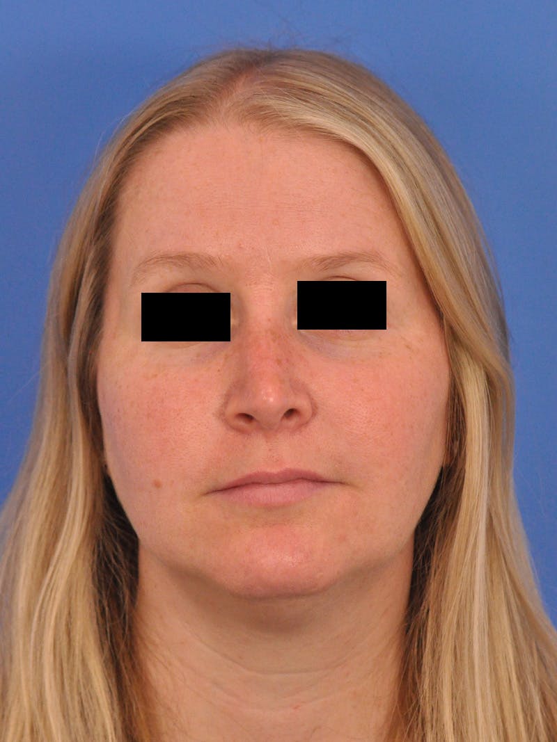 Rhinoplasty Before & After Gallery - Patient 157621 - Image 6