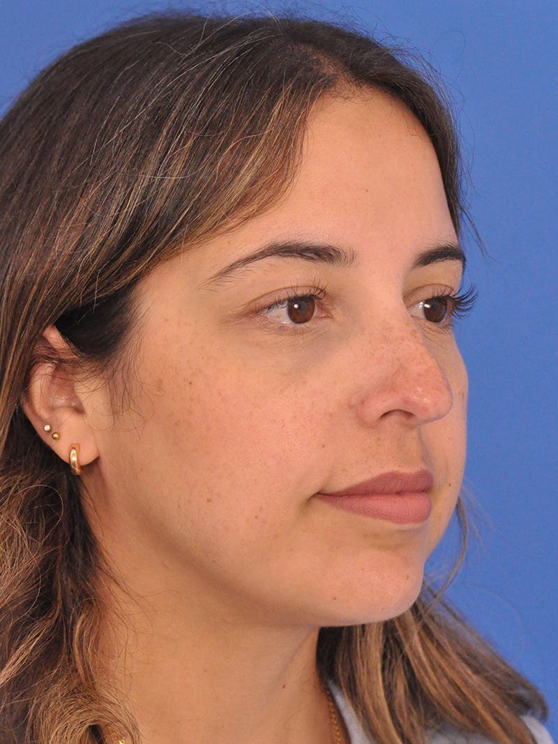 Rhinoplasty Before & After Gallery - Patient 277111 - Image 3