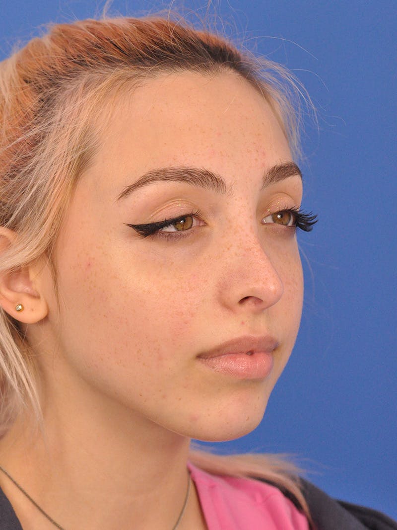 Rhinoplasty Before & After Gallery - Patient 192652 - Image 4