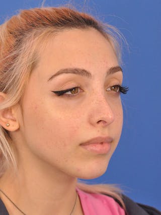 Rhinoplasty Before & After Gallery - Patient 192652 - Image 4
