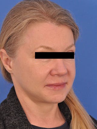 Facelift Before & After Gallery - Patient 202421 - Image 4