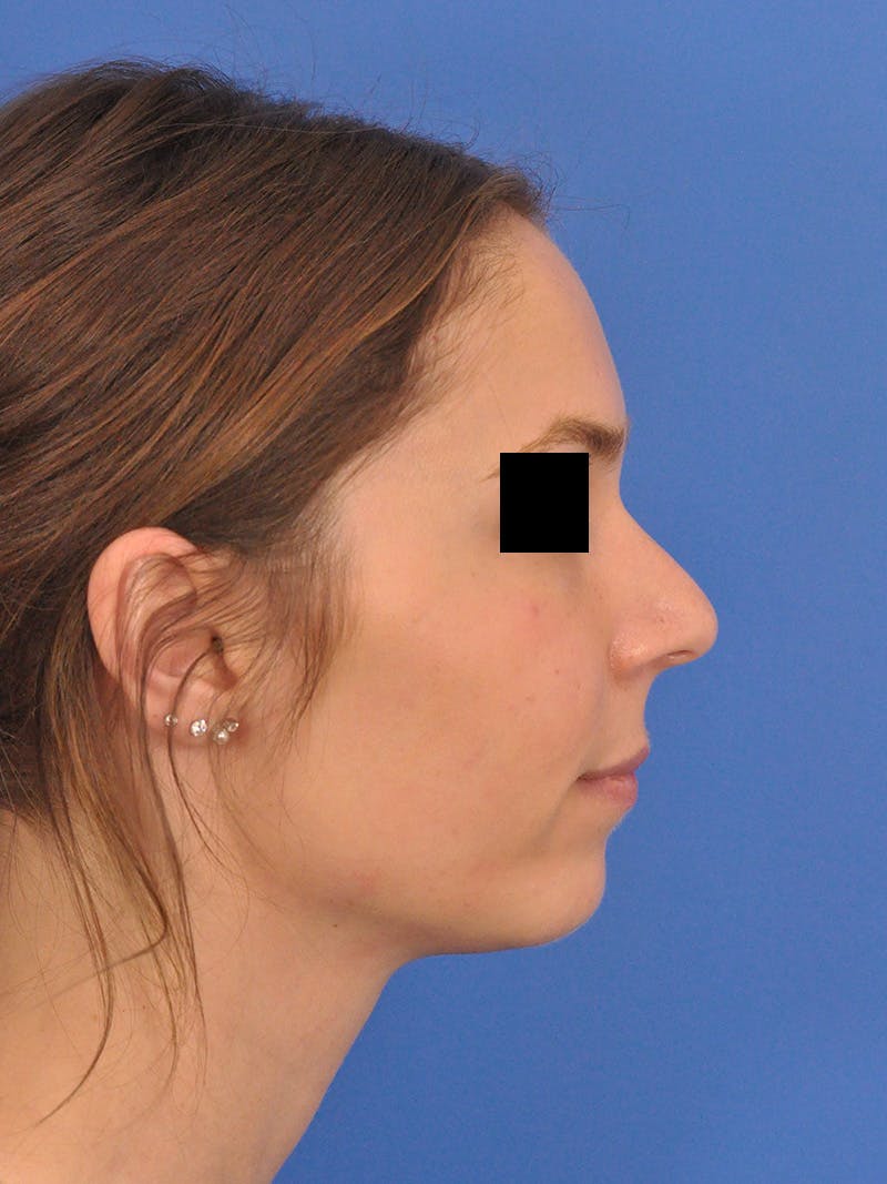 Rhinoplasty Before & After Gallery - Patient 230732 - Image 1