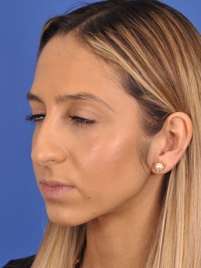 Rhinoplasty Before & After Gallery - Patient 587792 - Image 9
