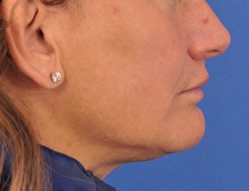 Lip Lift Before & After Gallery - Patient 271870 - Image 8