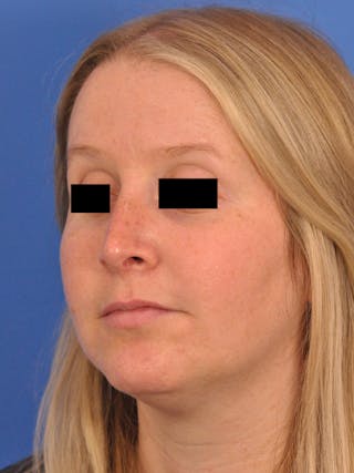 Rhinoplasty Before & After Gallery - Patient 157621 - Image 8