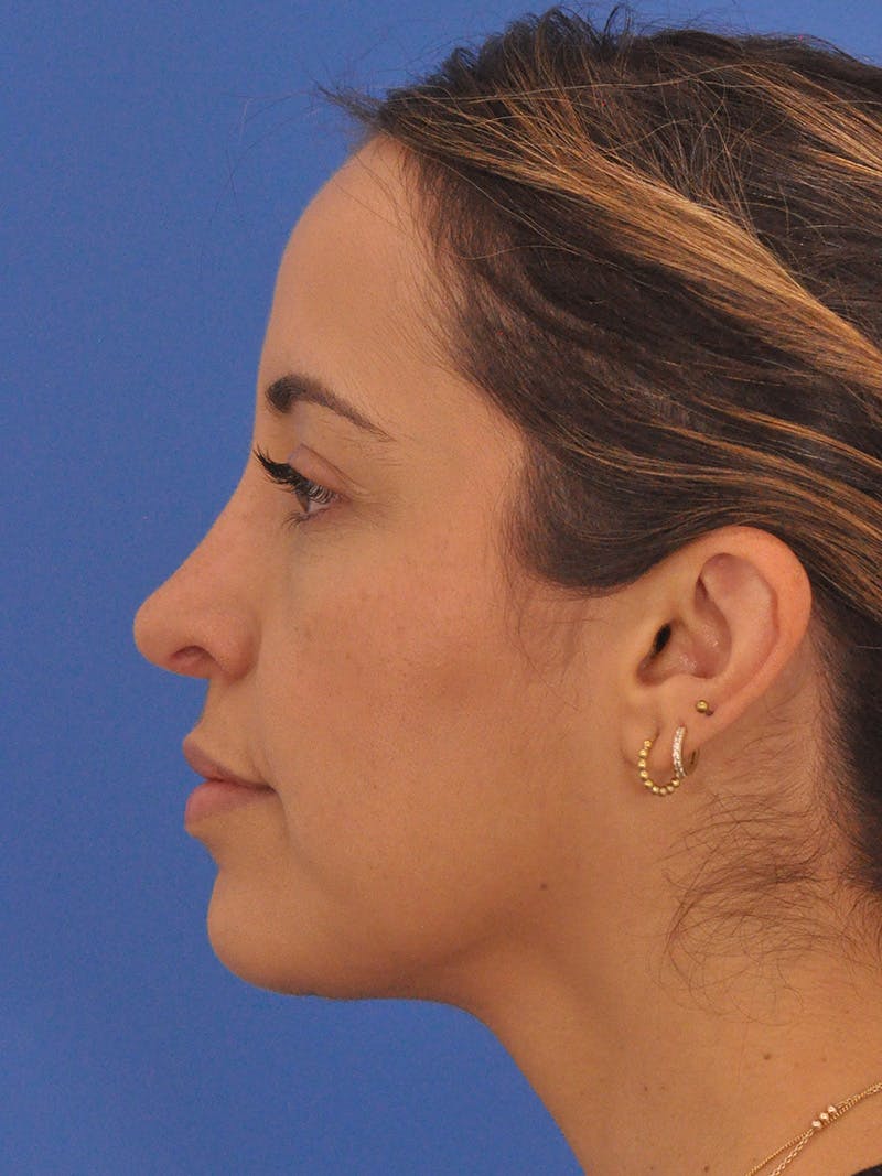 Rhinoplasty Before & After Gallery - Patient 277111 - Image 10