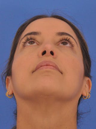 Rhinoplasty Before & After Gallery - Patient 277111 - Image 12