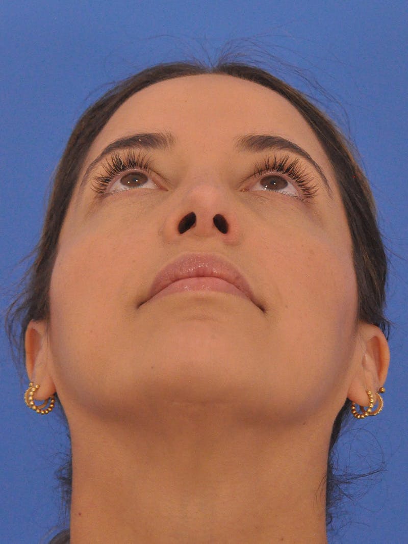 Rhinoplasty Before & After Gallery - Patient 277111 - Image 12