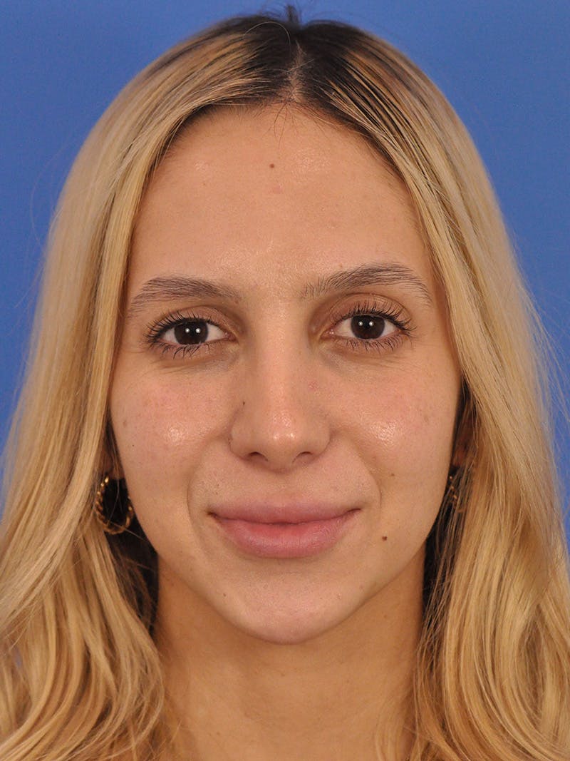 Rhinoplasty Before & After Gallery - Patient 587792 - Image 6