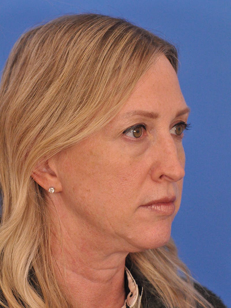 Rhinoplasty Before & After Gallery - Patient 315321 - Image 3