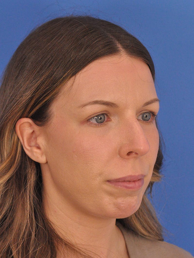 Rhinoplasty Before & After Gallery - Patient 135722 - Image 3