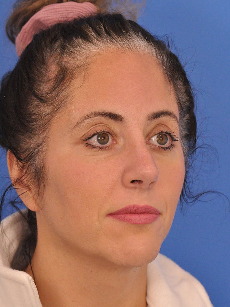 Rhinoplasty Before & After Gallery - Patient 347488 - Image 4