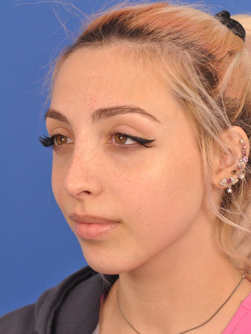 Rhinoplasty Before & After Gallery - Patient 192652 - Image 10