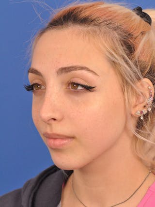 Rhinoplasty Before & After Gallery - Patient 192652 - Image 10