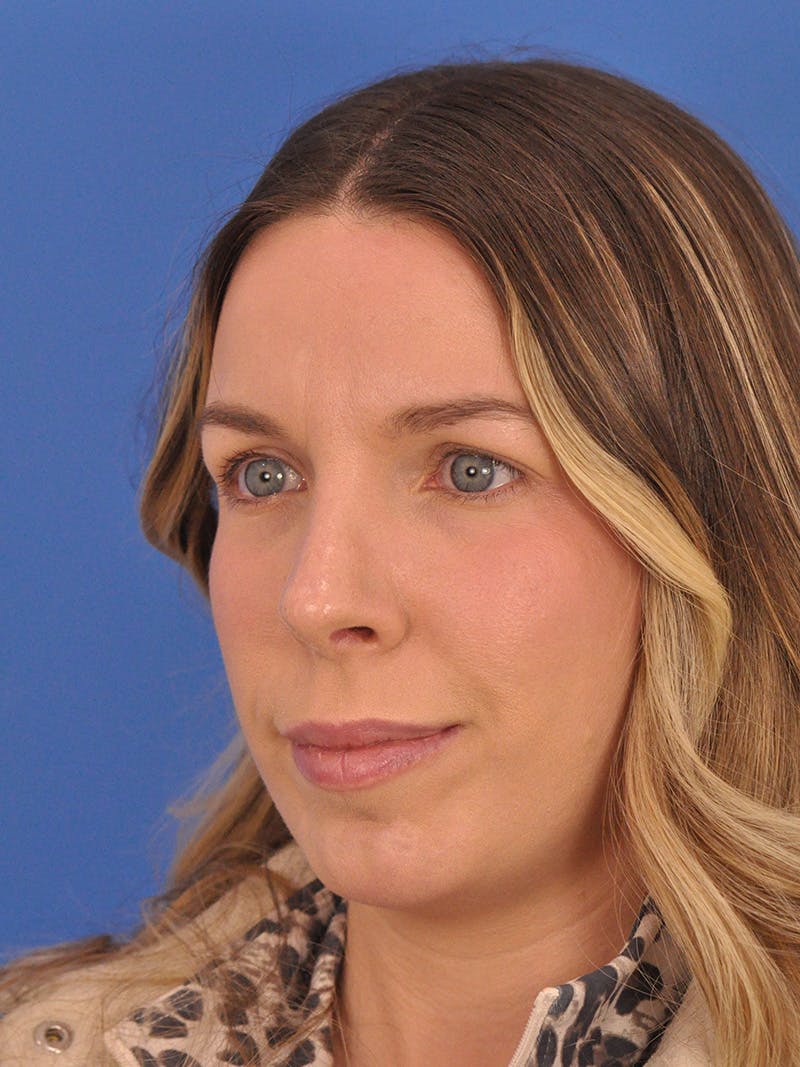 Rhinoplasty Before & After Gallery - Patient 135722 - Image 8