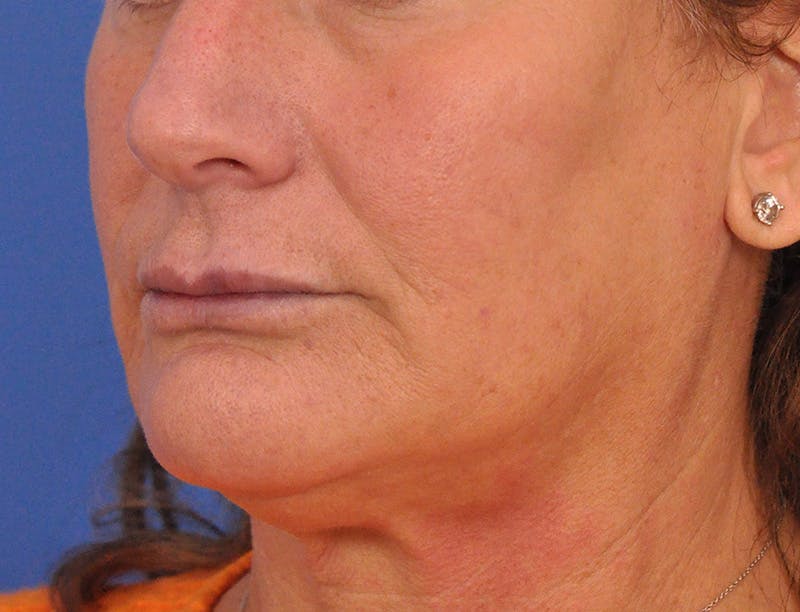 Lip Lift Before & After Gallery - Patient 271870 - Image 9