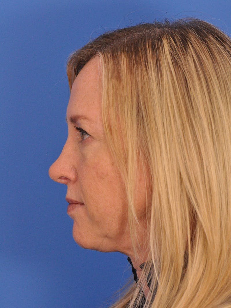 Rhinoplasty Before & After Gallery - Patient 315321 - Image 12