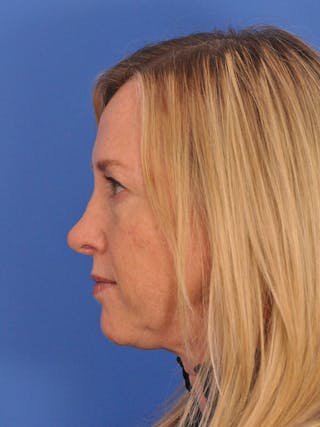Rhinoplasty Before & After Gallery - Patient 315321 - Image 12