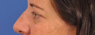 Blepharoplasty Before & After Gallery - Patient 378731 - Image 10